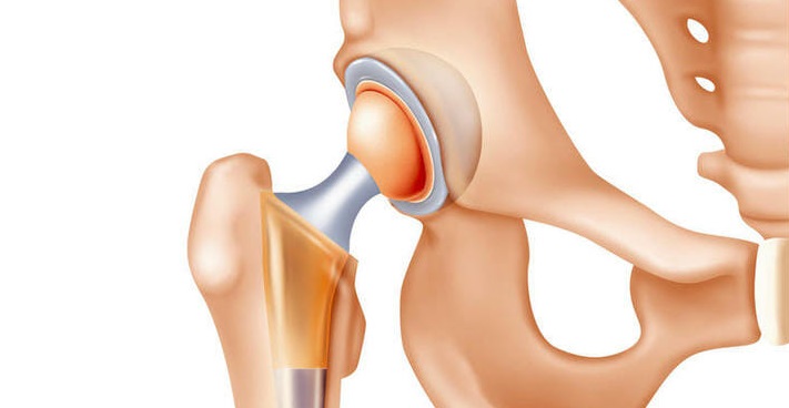 Protesi d’anca con rivestimento in ceramica: la Società Italiana di Ortopedia e Traumatologia fa chiarezza