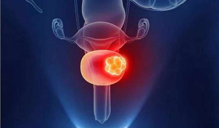 Merck e Pfizer, carcinoma uroteliale localmente avanzato o metastatico: la Commissione Europea approva avelumab