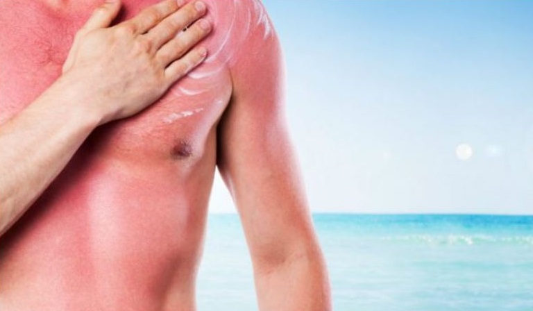 Fotosensibilità: con il sole non si scherza